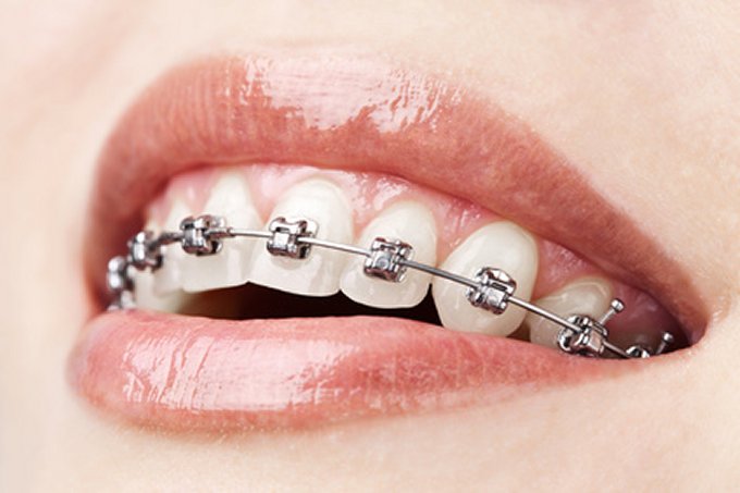 החיוך השקוף - יישור שיניים אינויזליין Invisalign